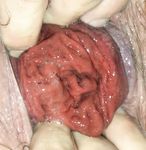 Prolapse and BallsGame