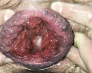 Prolapse and BallsGame