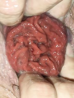 Prolapse and BallsGame