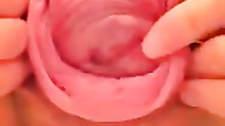 Huge prolapse close-up