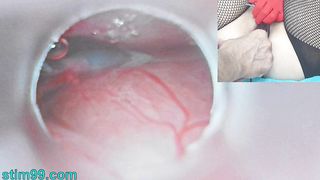 Japanese Mom Insemination Cum in Uterus and Endoscope Cam