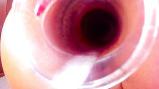 Prolapse 9